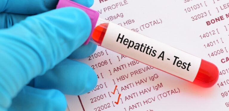 Campania, la regione consolida  la risposta all’Epatite A e rafforza controlli, sorveglianza e prevenzione 